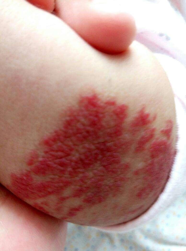 去紅色胎記多少錢？