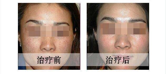 激光<a href=http://www.bolangguoji.com/listinfo-786-0.html target=_blank class=infotextkey>去黃褐斑</a>多少錢？