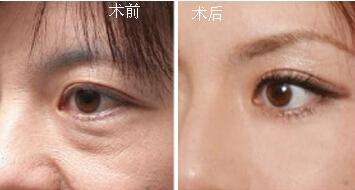 做完提眉術(shù)后的效果怎么樣？