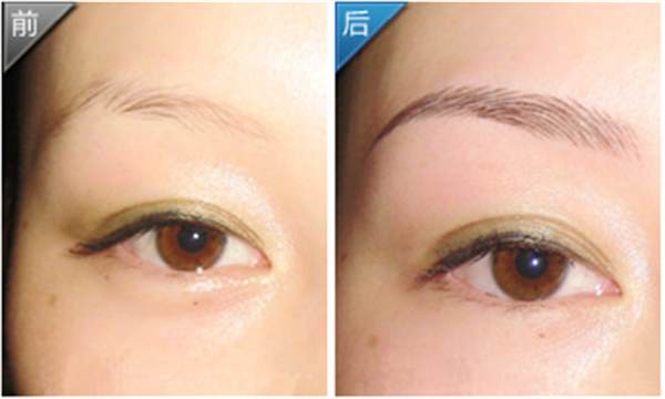<a href=http://www.bolangguoji.com/listinfo-655-0.html target=_blank class=infotextkey>切眉</a>術的原理？