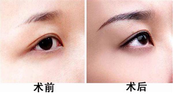 <a href=http://www.bolangguoji.com/listinfo-655-0.html target=_blank class=infotextkey>切眉</a>術(shù)與提眉術(shù)對(duì)比？