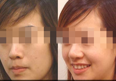 韓式<a href=http://www.bolangguoji.com/listinfo-737-0.html target=_blank class=infotextkey>隆鼻</a>有沒有副作用?