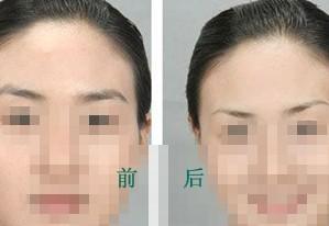 <a href=http://www.bolangguoji.com/listinfo-655-0.html target=_blank class=infotextkey>切眉</a>術(shù)的手術(shù)過程步驟及術(shù)后護理？