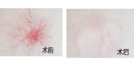 告訴你長蜘蛛痣的原因是什么