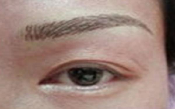 怎么樣避免提眉術(shù)的副作用？