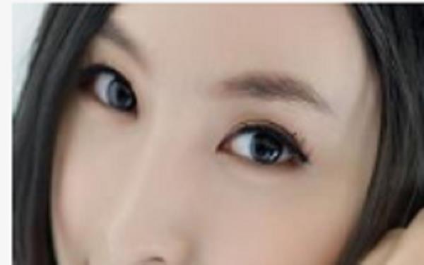 提眉術后多久可以恢復自然？