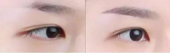<a href=http://www.bolangguoji.com/listinfo-655-0.html target=_blank class=infotextkey>切眉</a>手術(shù)過程是怎樣的呢？