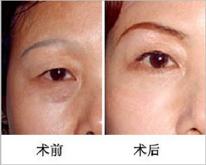 提眉術(shù)適應(yīng)癥是？