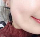 酒窩手術失敗圖片