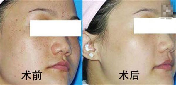 廣州<a href=http://www.bolangguoji.com/listinfo-786-0.html target=_blank class=infotextkey>去黃褐斑</a>方法哪種有效