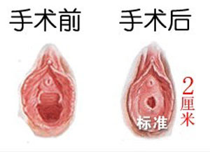 <a href=http://www.bolangguoji.com/listinfo-805-0.html target=_blank class=infotextkey>處女膜修復(fù)</a>前后對(duì)比圖