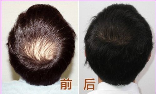 常見值發術后的護理方法
