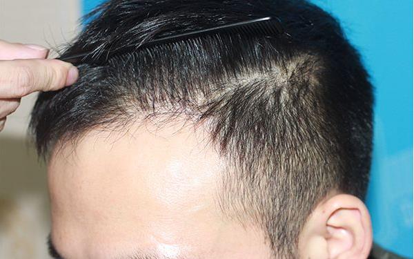<a href=http://www.bolangguoji.com/listinfo-662-0.html target=_blank class=infotextkey>治療脫發</a>的方法