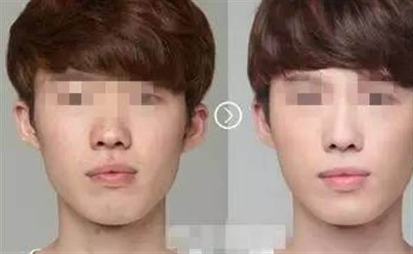 男人也可以做<a href=http://www.bolangguoji.com/listinfo-737-0.html target=_blank class=infotextkey>隆鼻</a>手術(shù)