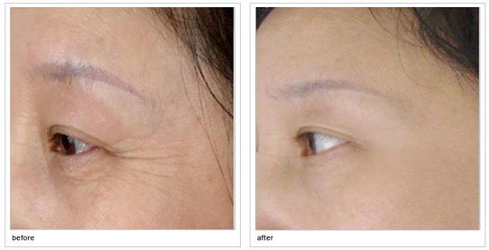 注射botox<a href=http://www.bolangguoji.com/listinfo-614-0.html target=_blank class=infotextkey>除皺</a>瘦型素<a href=http://www.bolangguoji.com/listinfo-614-0.html target=_blank class=infotextkey>除皺</a>瘦型素<a href=http://www.bolangguoji.com/listinfo-614-0.html target=_blank class=infotextkey>除皺</a>維持的時(shí)間是多久