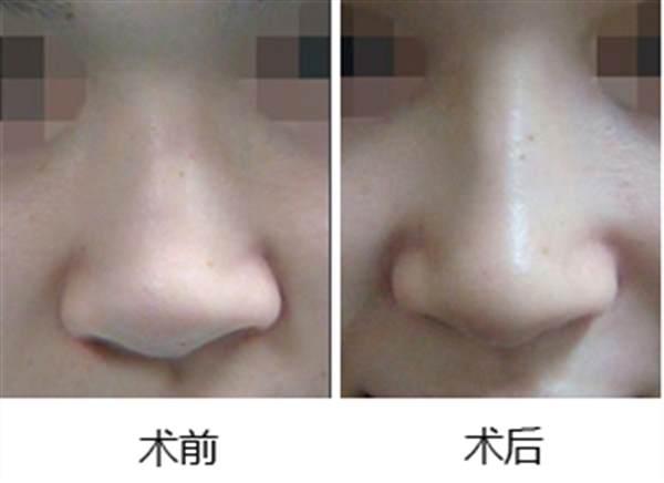 <a href=http://www.bolangguoji.com/listinfo-737-0.html target=_blank class=infotextkey>隆鼻</a>術(shù)注意事項(xiàng)