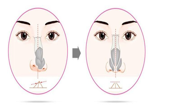 <a href=http://www.bolangguoji.com/listinfo-751-0.html target=_blank class=infotextkey>歪鼻矯正</a>手術如何護理