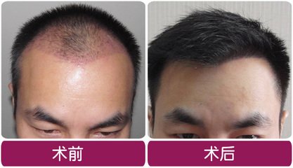 做植發手術要多少錢