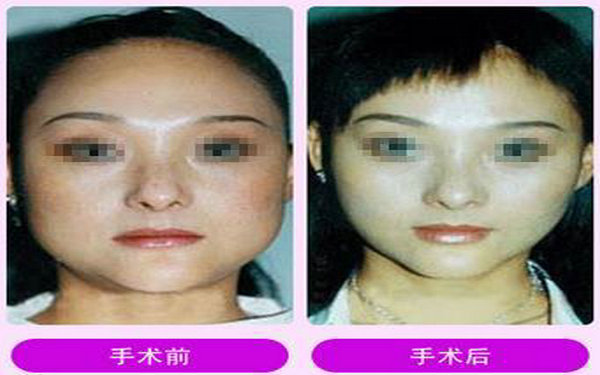 磨骨<a href=http://www.bolangguoji.com/listinfo-631-0.html target=_blank class=infotextkey>瘦臉</a>術要多少錢?