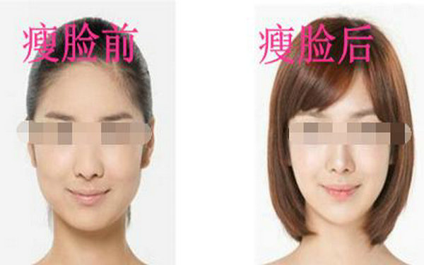 磨腮多少錢?