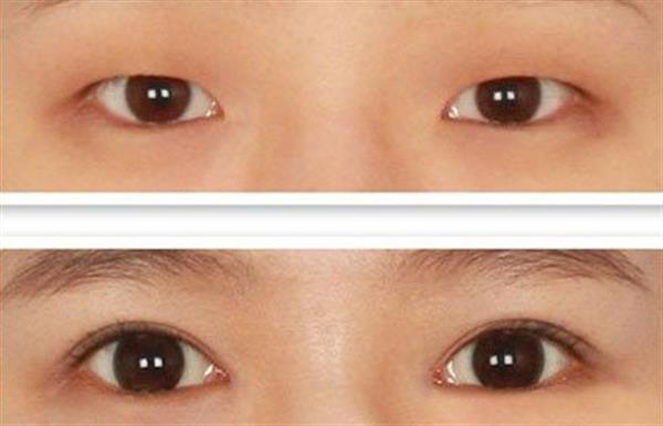 割<a href=http://www.bolangguoji.com/listinfo-724-0.html target=_blank class=infotextkey>雙眼皮</a>幾個月定型