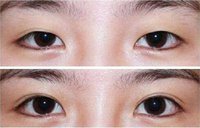 有關切開<a href=http://www.bolangguoji.com/listinfo-724-0.html target=_blank class=infotextkey>雙眼皮</a>的術前準備