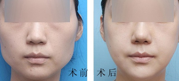 <a href=http://www.bolangguoji.com/listinfo-629-0.html target=_blank class=infotextkey>下頜角</a>手術特點是什么