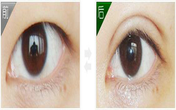 哪個季節割<a href=http://www.bolangguoji.com/listinfo-724-0.html target=_blank class=infotextkey>雙眼皮</a>較好?
