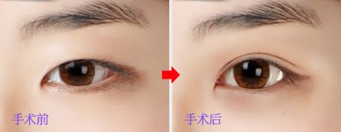 <a href=http://www.bolangguoji.com/listinfo-724-0.html target=_blank class=infotextkey>雙眼皮</a>埋線法可保幾年