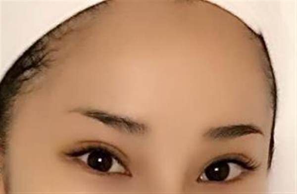 額頭小整容的方法有哪些