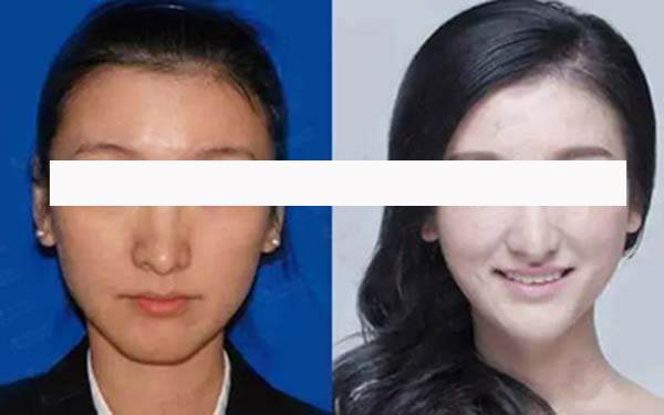 如何去掉雙下巴
