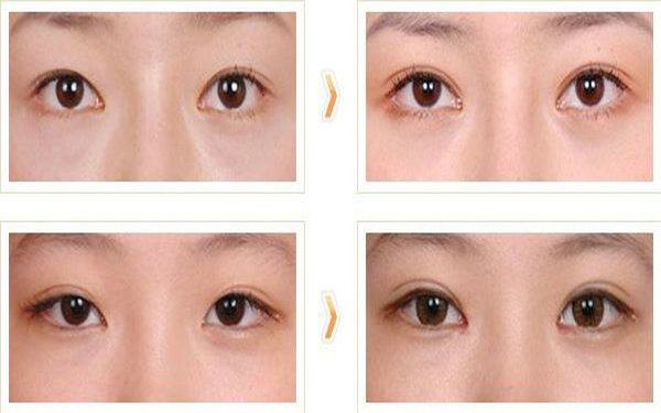 哪些人不適合做<a href=http://www.bolangguoji.com/listinfo-724-0.html target=_blank class=infotextkey>雙眼皮</a>?