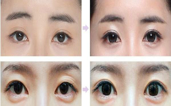 納米<a href=http://www.bolangguoji.com/listinfo-724-0.html target=_blank class=infotextkey>雙眼皮</a>多久能化妝?
