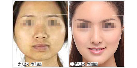 透明質酸豐太陽的并發癥有哪些