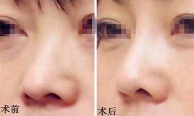 膨體太高可以變矮么