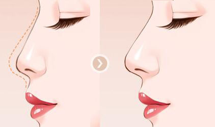 南京假體<a href=http://www.bolangguoji.com/listinfo-737-0.html target=_blank class=infotextkey>隆鼻</a>手術價格