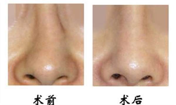<a href=http://www.bolangguoji.com/listinfo-751-0.html target=_blank class=infotextkey>歪鼻矯正</a>手術的后遺癥及禁忌