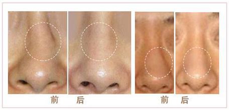  假體<a href=http://www.bolangguoji.com/listinfo-737-0.html target=_blank class=infotextkey>隆鼻</a>慢性排異反應