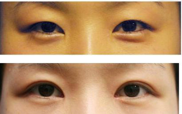 納米無(wú)痕<a href=http://www.bolangguoji.com/listinfo-724-0.html target=_blank class=infotextkey>雙眼皮</a>的危害?