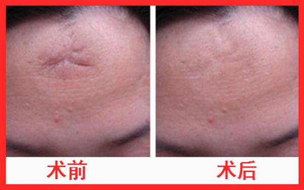 凹陷疤痕消磨術(shù)有用嗎