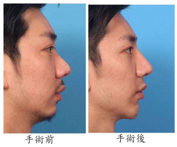 墊下巴和<a href=http://www.bolangguoji.com/listinfo-737-0.html target=_blank class=infotextkey>隆鼻</a>哪個(gè)痛苦