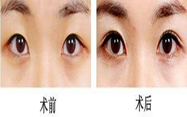 內(nèi)雙割什么<a href=http://www.bolangguoji.com/listinfo-724-0.html target=_blank class=infotextkey>雙眼皮</a>好看?