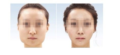 下頜骨手術后要包多久