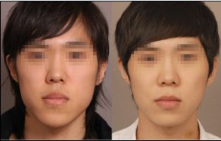 下頜骨偏斜如何處理
