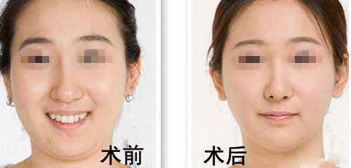 怎樣減<a href=http://www.bolangguoji.com/listinfo-638-0.html target=_blank class=infotextkey>去雙下巴</a>