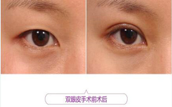 切開<a href=http://www.bolangguoji.com/listinfo-724-0.html target=_blank class=infotextkey>雙眼皮</a>幾天拆線?