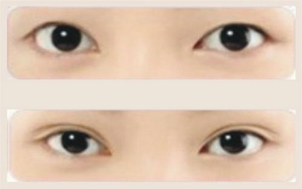 切<a href=http://www.bolangguoji.com/listinfo-724-0.html target=_blank class=infotextkey>雙眼皮</a>恢復(fù)時(shí)間
