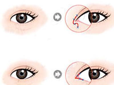 <a href=http://www.bolangguoji.com/listinfo-711-0.html target=_blank class=infotextkey>開(kāi)眼角</a>留疤怎么辦