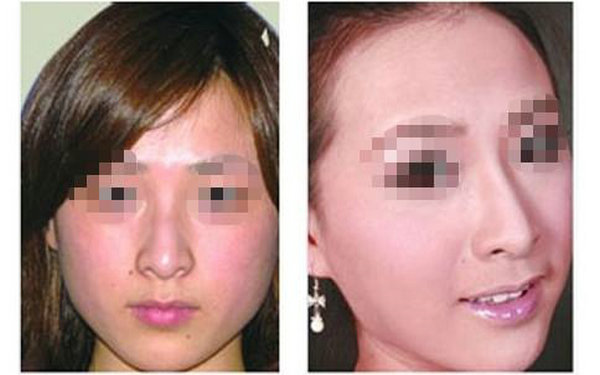 哪些人不適合硅膠<a href=http://www.bolangguoji.com/listinfo-737-0.html target=_blank class=infotextkey>隆鼻</a>?