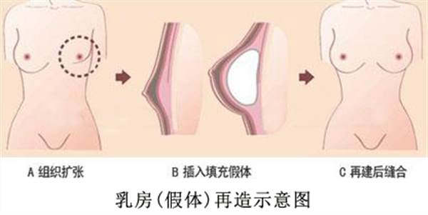 <a href=http://www.bolangguoji.com/listinfo-620-0.html target=_blank class=infotextkey>乳房再造</a>有副作用嗎